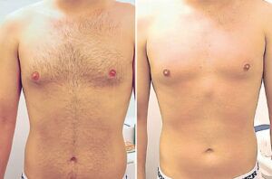 Laser Hair Removal Services For Men