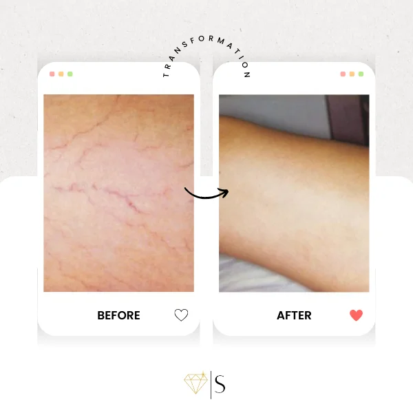 spoiledlaser