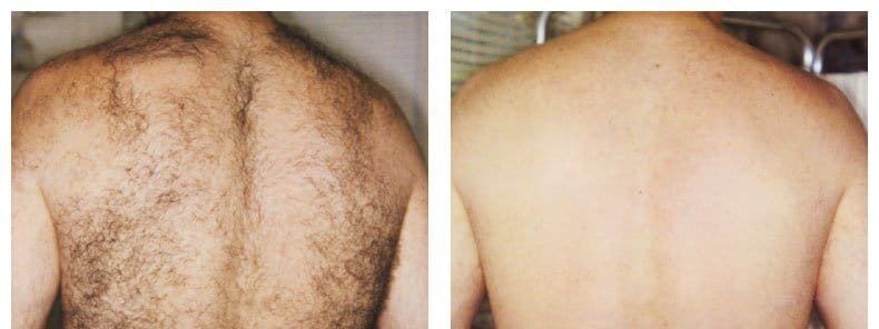 Men's Laser Hair Removal