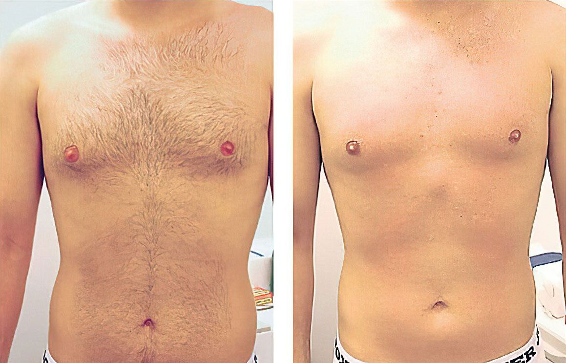 Laser Hair Removal Services For Men