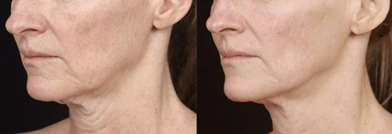 skin tightening
